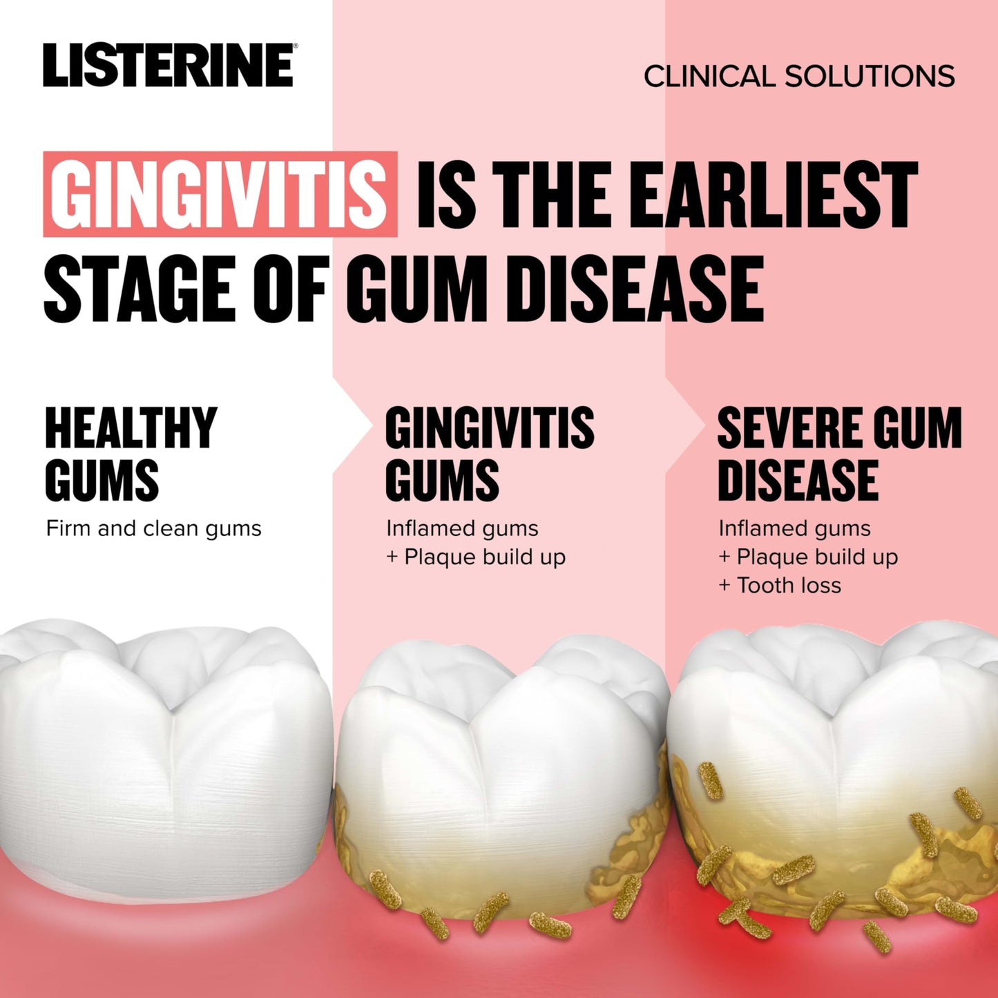 Listerine Clinical Solutions Gum Health Antiseptic Mouthwash, Antigingivitis & Antiplaque Oral Rinse Helps Prevent Buildup & Kills Germs for Healthier Gums, ICY Mint, Twin Pack, 1 L, 2 Pack
